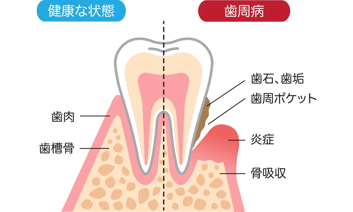 歯周病予防